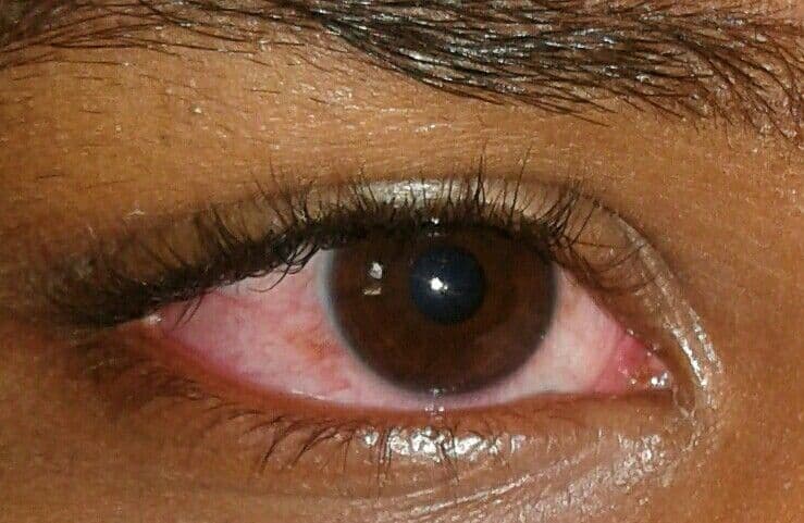Understanding Dry Eye Syndrome: Root Causes, Screen Habits & Clinical Relief - St Mary Optical eye care insights