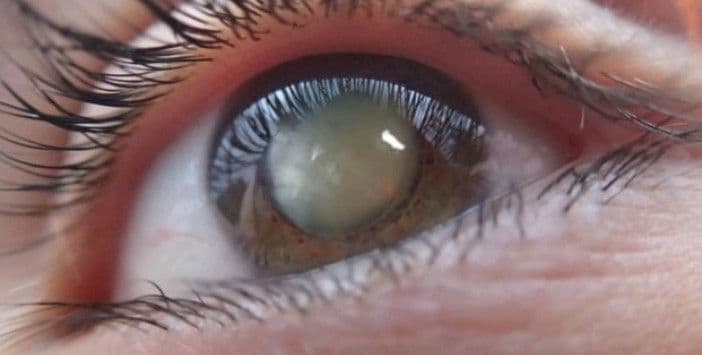 Glaucoma & Intraocular Pressure: Why the "Silent Thief of Sight" Needs Early Detection - eye care guide by St Mary Optical Nairobi