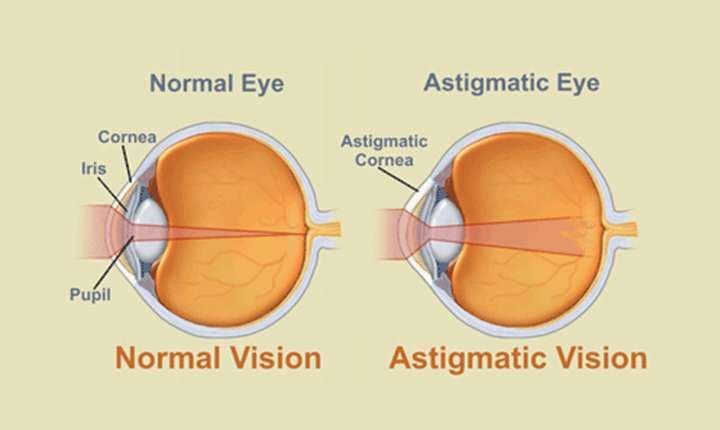 Demystifying Astigmatism: Why It Blurs Vision & How Toric Lenses Fix It - St Mary Optical eye care insights